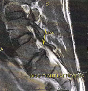 Омыртқаның MRI - L5 және S1 жүйке тамырларының қысылуымен L5-S1 гелиотренациясы