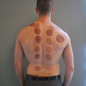 man after cupping technique, Dr. Justin Jelen, bruises